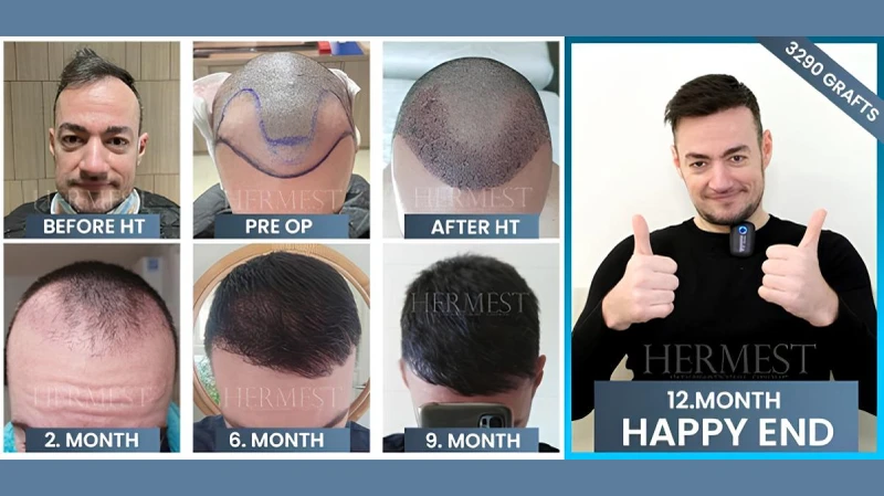 Eine Übersicht von den Vorher-Nachher-Ergebnissen 2026 der Hermest Hair Clinic