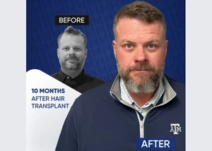 Vor- und Nachher-Vergleich einer Haartransplantation