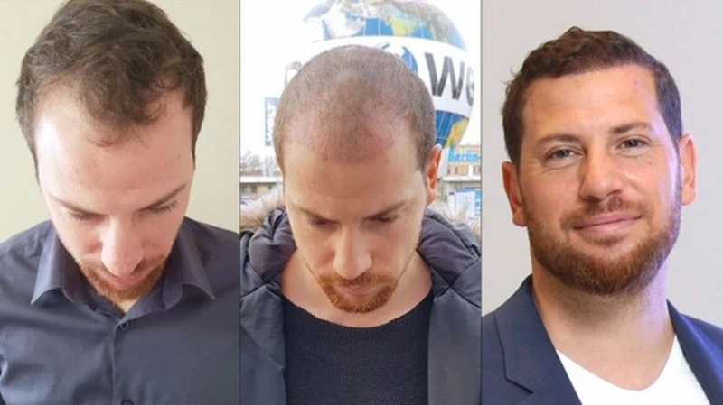 3 Vorher-Nachher-Bilder von Florians Haartransplantation in der Türkei