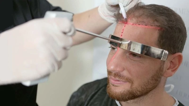 Ein Doktor von Hermest zeichnet eine dem Gesichtsprofil angepasste Haarlinie für eine Haartransplantationsoperation