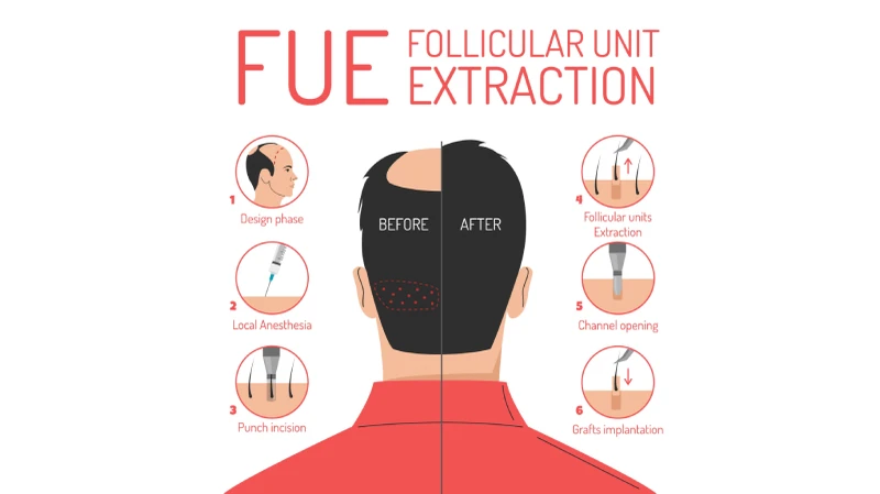 Medizinische Infografik zum Ablauf der FUE Haartransplantation Methode