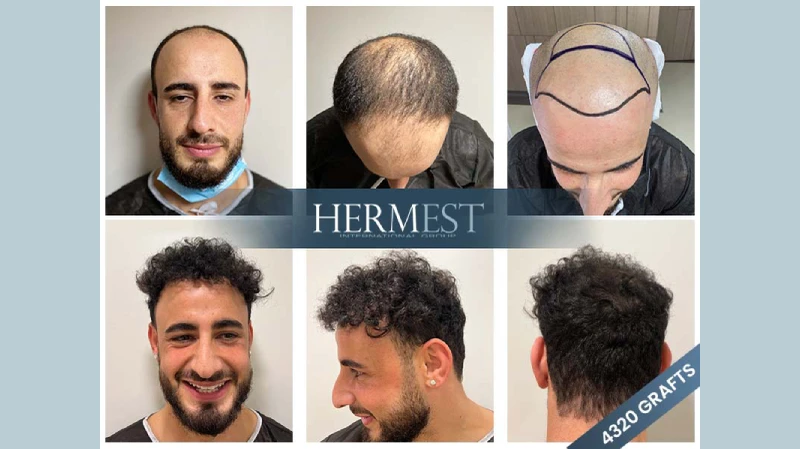 Ergebnisse von Haartransplantationen, © Hermest Hair Clinic