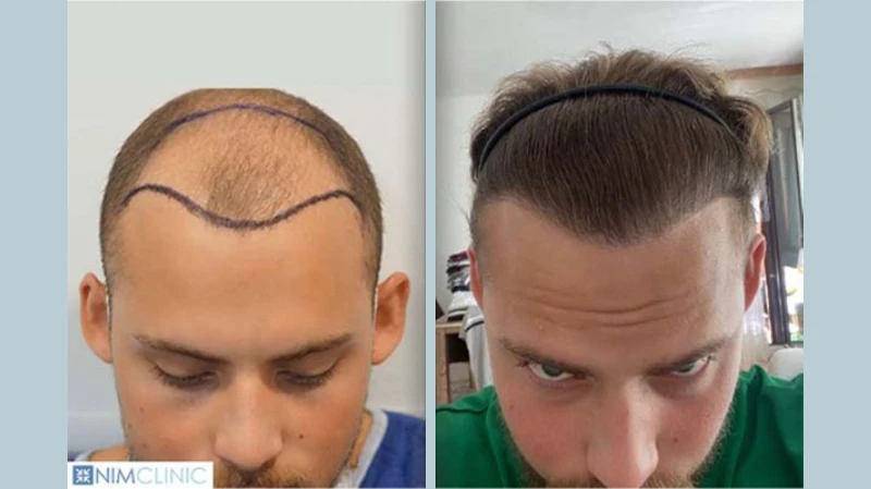 Ein Männerkopf vor und nach der Haartransplantation