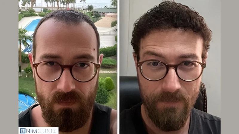 Erfahrungen und Ergebnisse einer Haartransplantation Türkei bei Nim Clinic